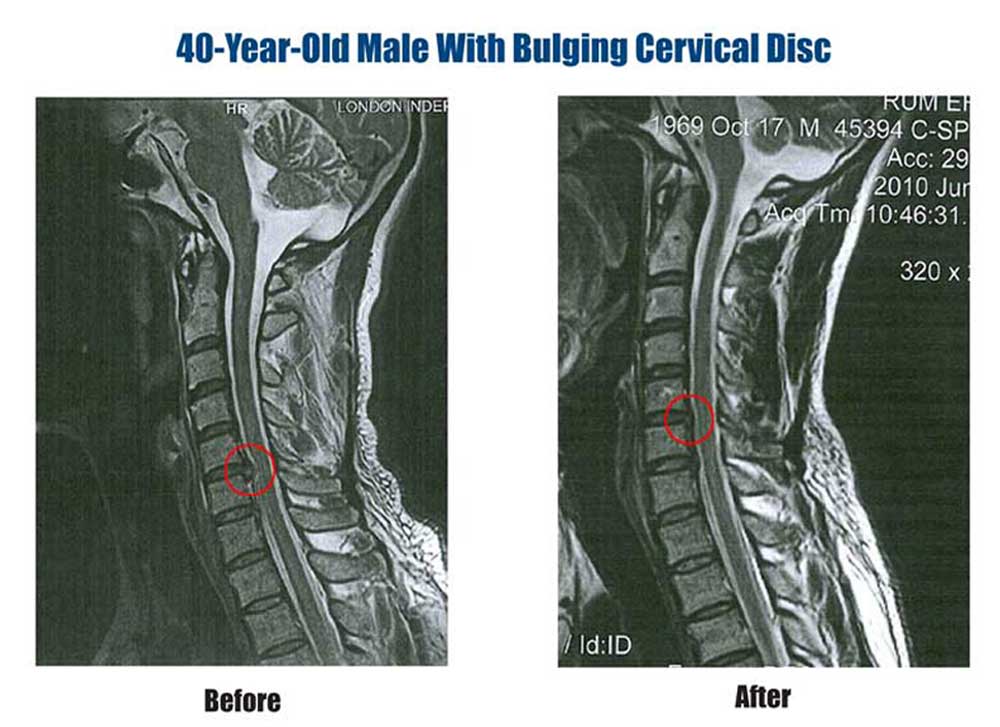 Before After Mri S In Fayetteville Simply Chiropractic